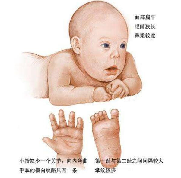 据统计,大概每700个活产婴儿中就有一名21三体综合征患儿出生.