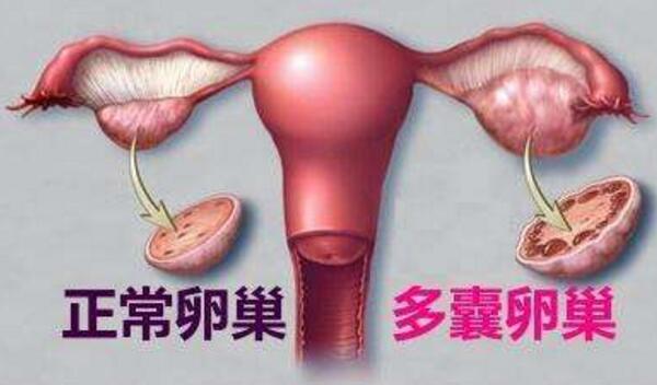 多囊卵巢1.jpg