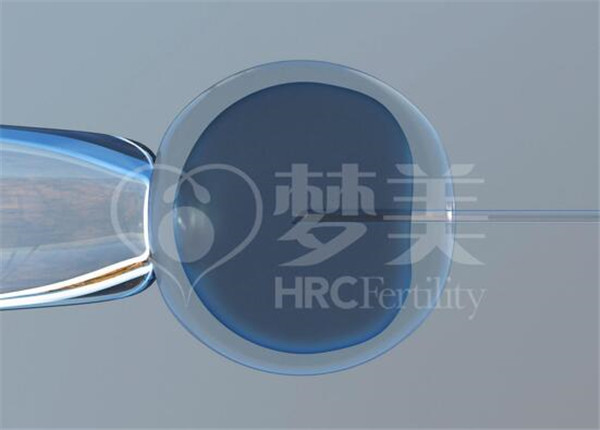 试管ICSI
