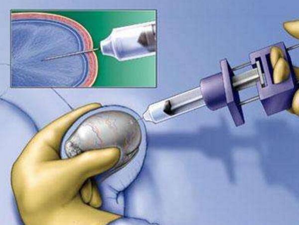 睾丸穿刺取精