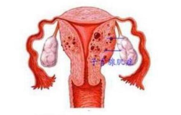 子宫腺肌症