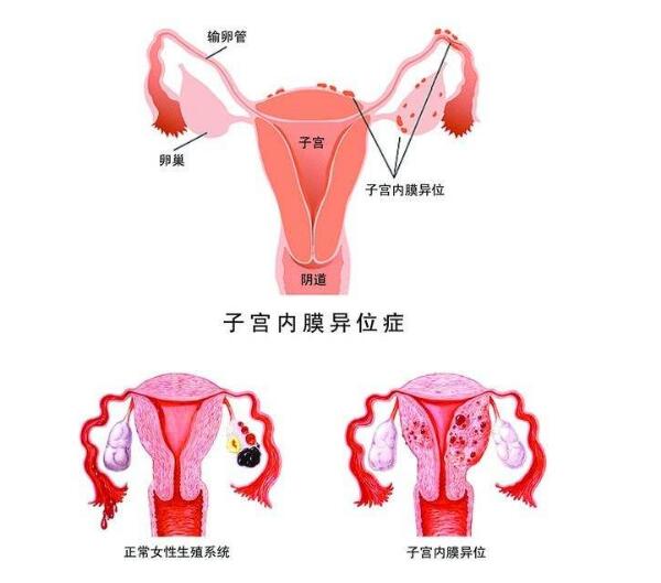 子宫内膜移位