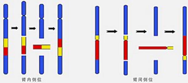 染色体平衡易位