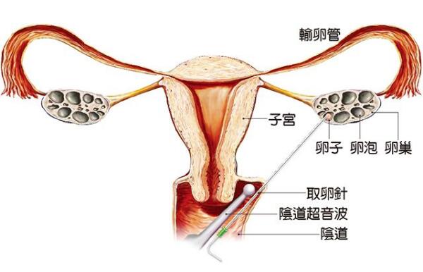 促排取卵