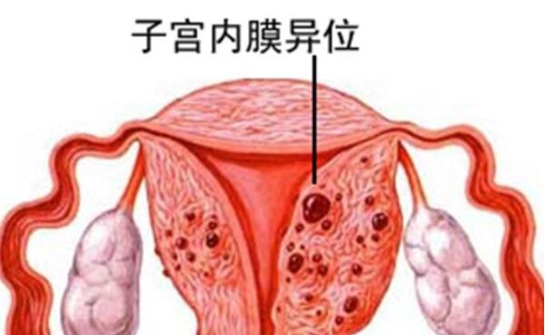 子宫内膜异位症