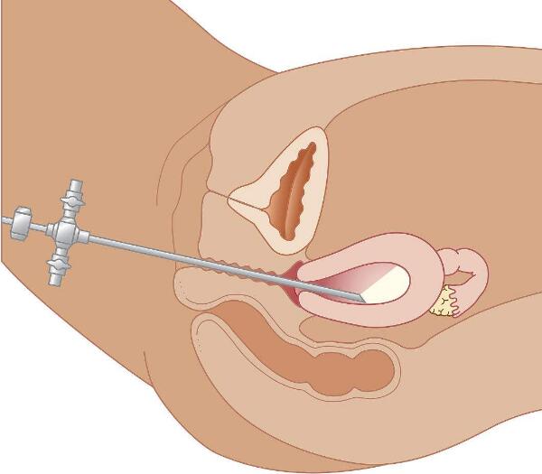 宫腔镜手术