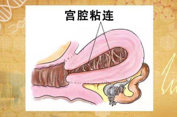 宫腔粘连