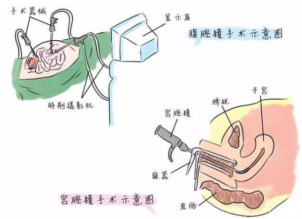 宫腔镜手术