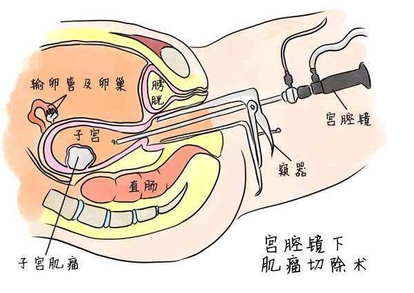 子宫肌瘤切除