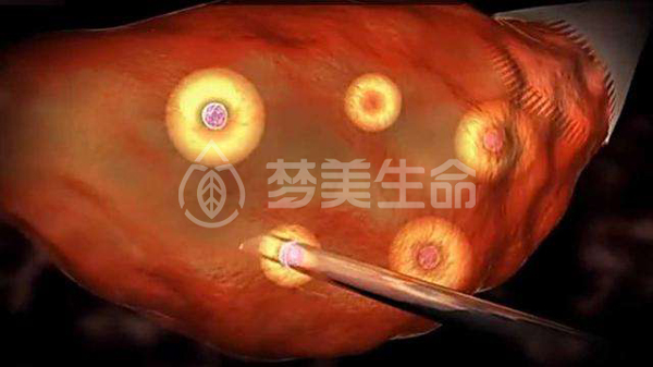 取卵4-梦美生命.jpg