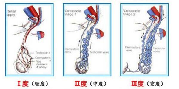 精索静脉曲张