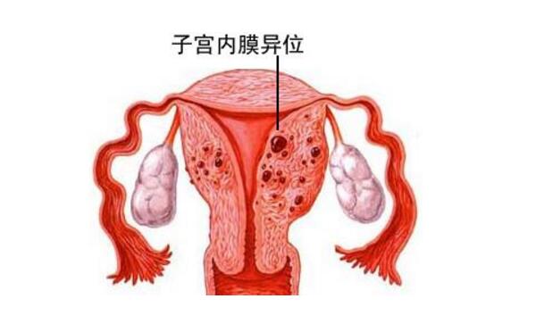 子宫内膜异位.jpg