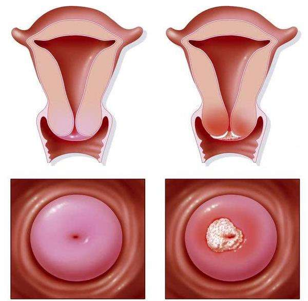 使得病原体隐藏于宫颈黏膜内而引起的慢性炎症