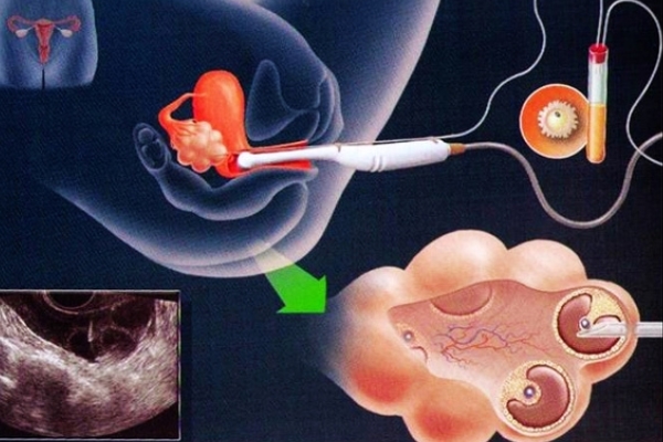 取卵手术