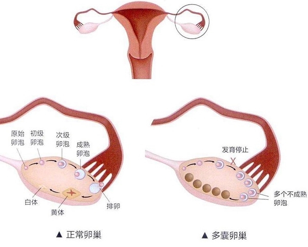 多囊卵巢