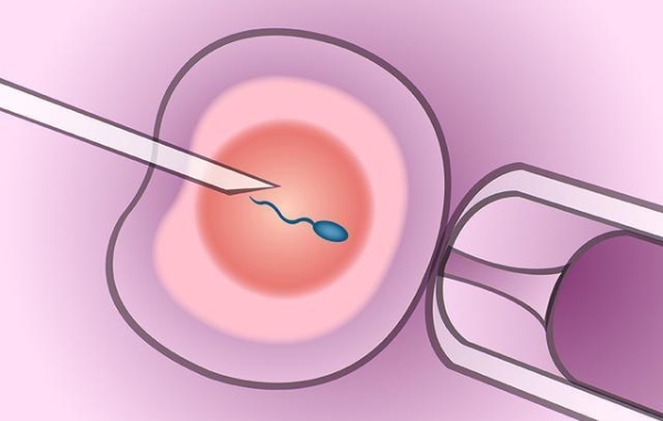 单精子注射