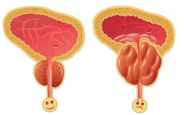 前列腺炎