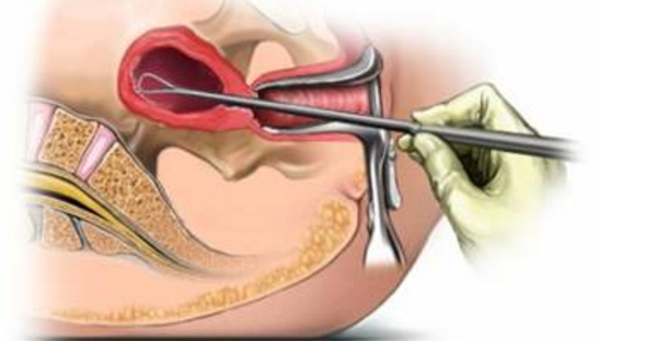 手术刮宫