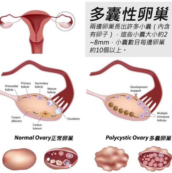 女性卵巢性疾病