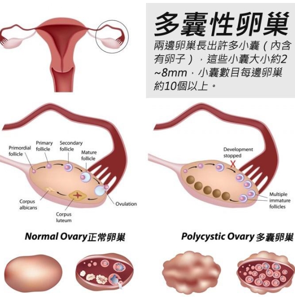 多囊卵巢
