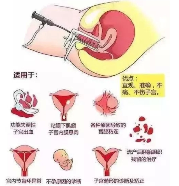 宫腔镜