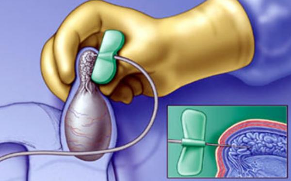 睾丸穿刺取精术