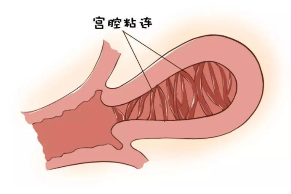 宫腔粘连