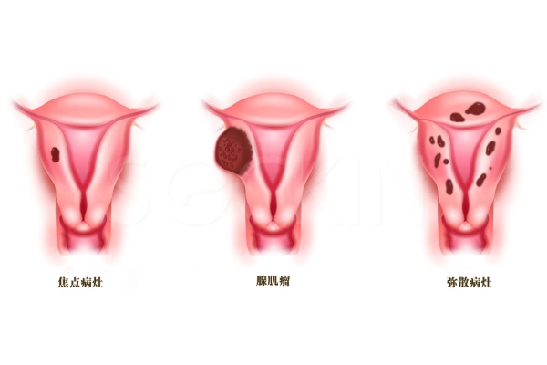 子宫腺肌症