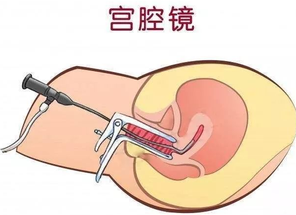 宫腔镜检查
