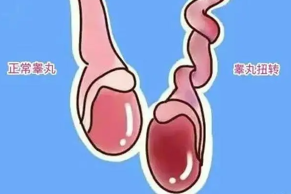 睾丸扭转