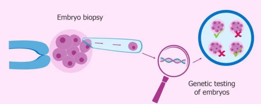 囊胚基因筛查诊断