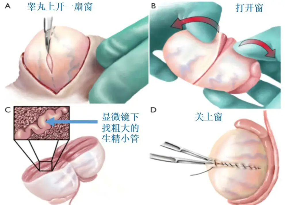 睾丸穿刺取精