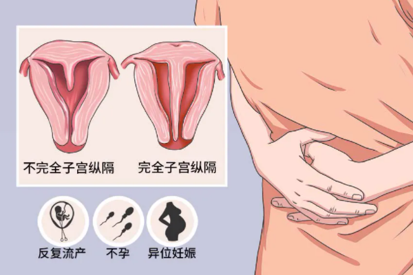 子宫纵膈