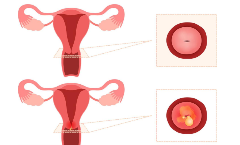 子宫炎症