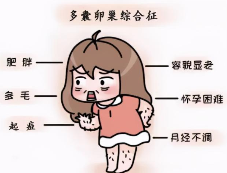 多囊卵巢综合征