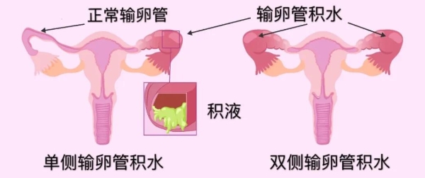 输卵管积水