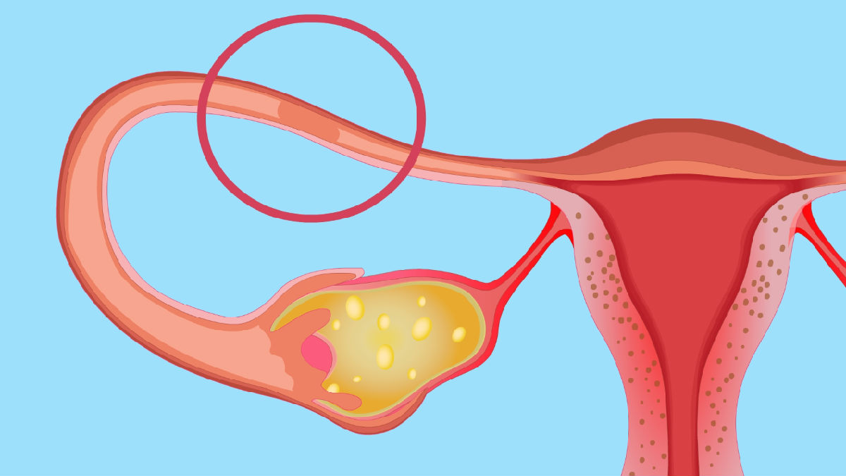 女性输卵管堵塞