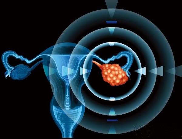 卵巢促排肿瘤