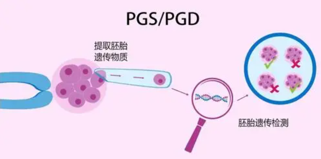 美国第三代试管婴儿技术