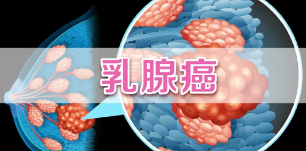 乳腺癌