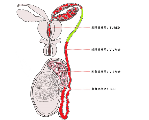 输精管道阻塞