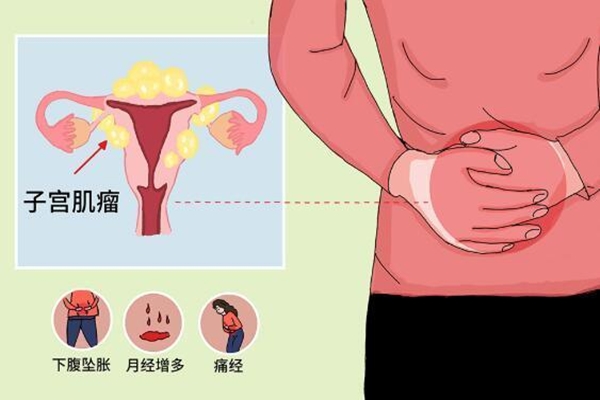 女性子宫肌瘤