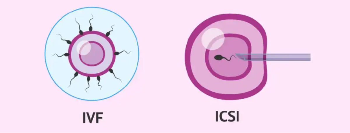 ICSI技术