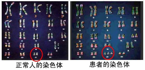 21对染色体