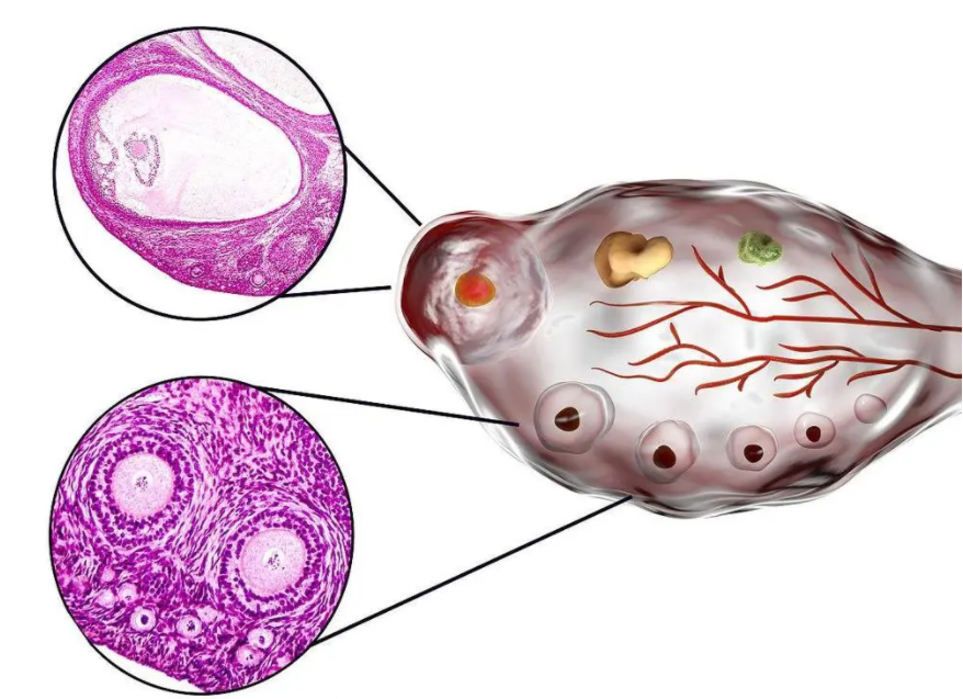 导致卵子数量减少