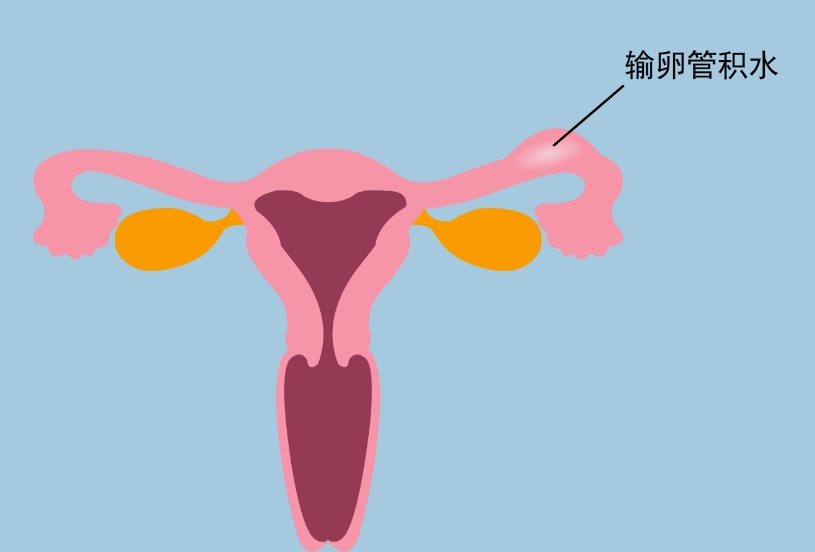 输卵管积水