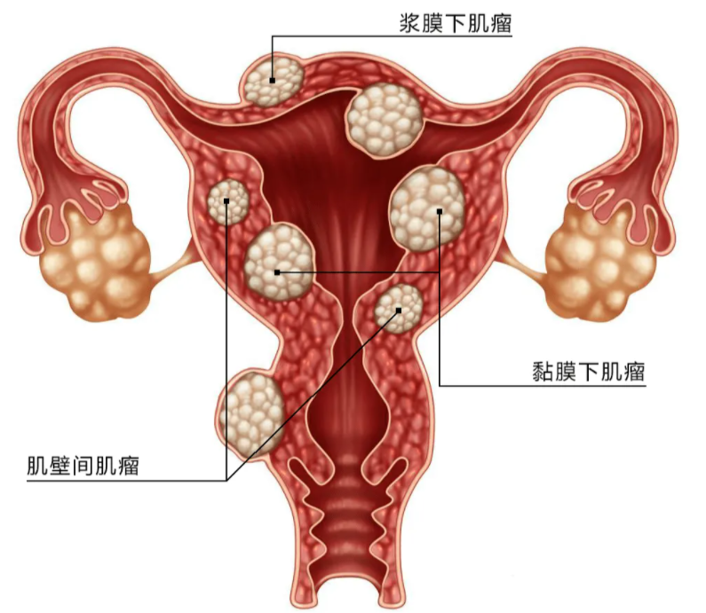 子宫肌瘤
