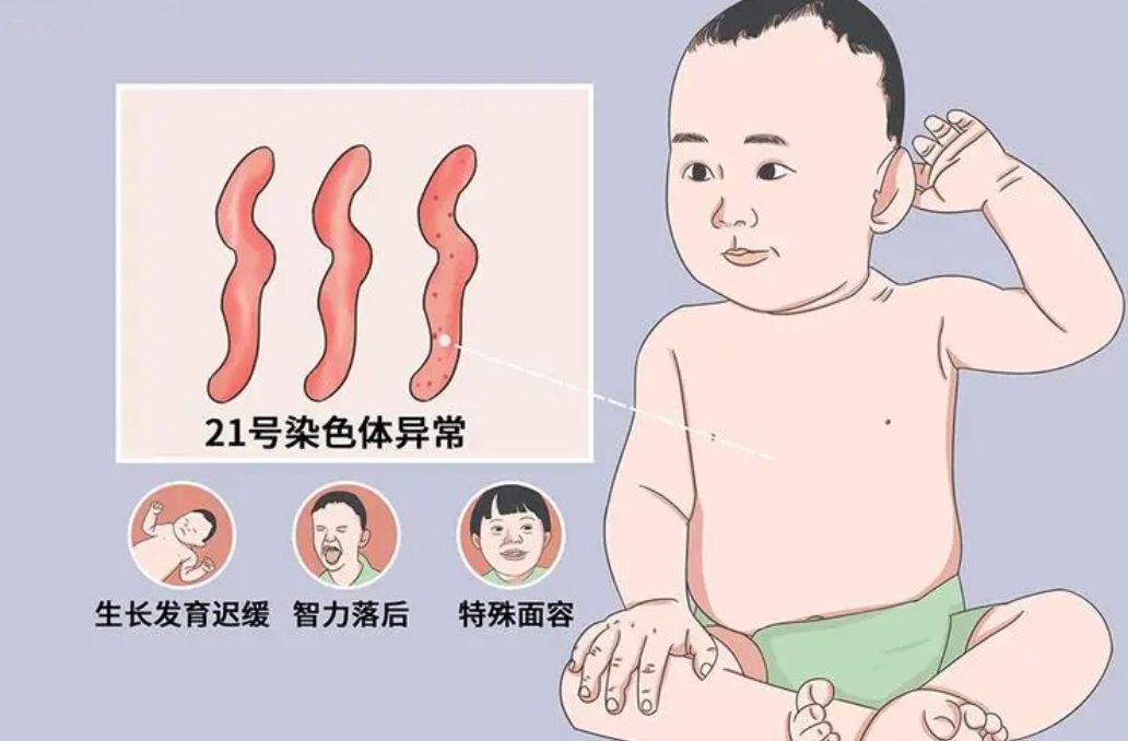 21号染色体异常