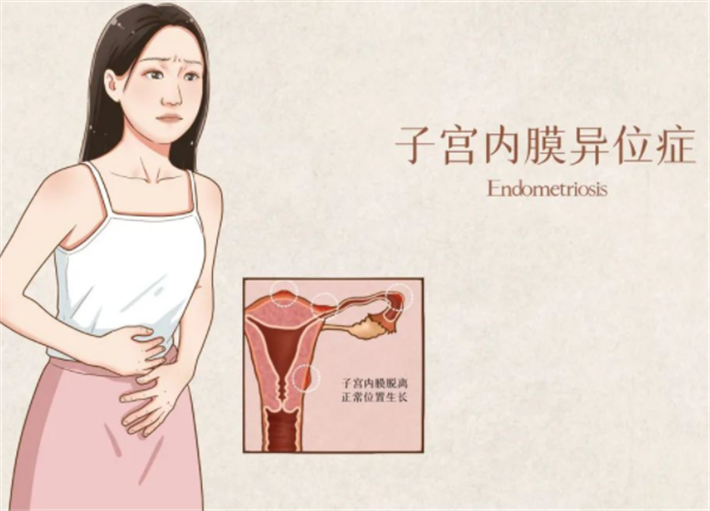 子宫内膜异位症2.png