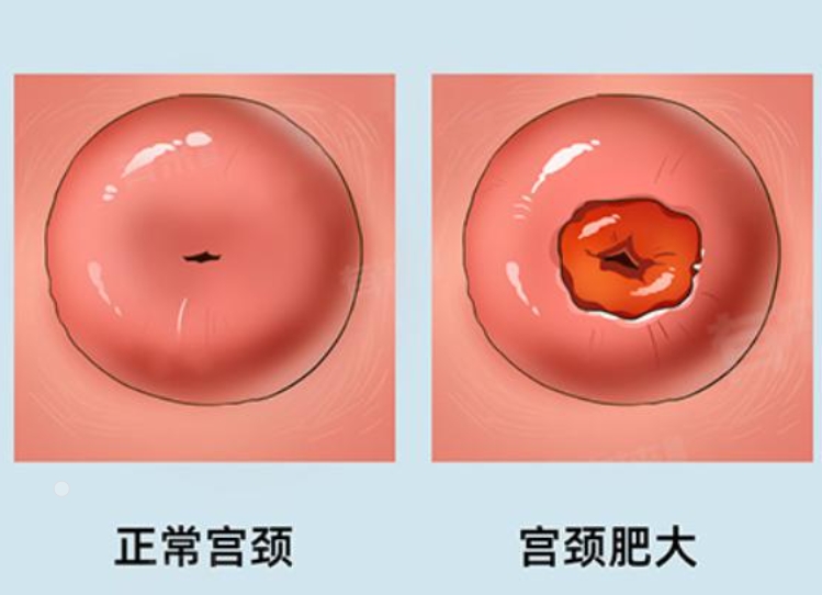 宫颈肥大